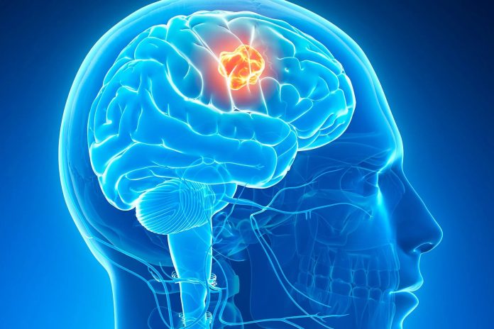 brain-tumors-1