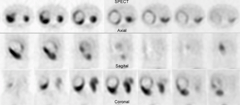 Octreoscan  με In111
