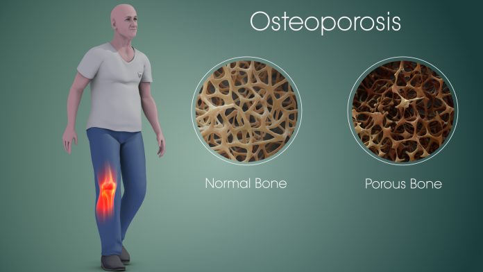 Male-Osteoporosis-1