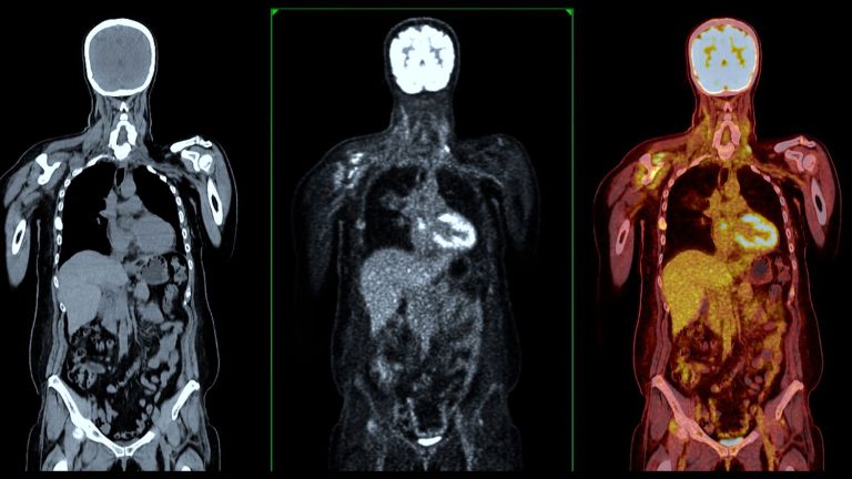 Το PET-CT SCAN είναι σημαντικό διαγνωστικό εργαλείο