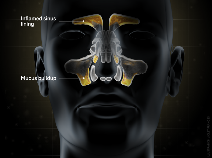 natural-nasal-decongestants-2
