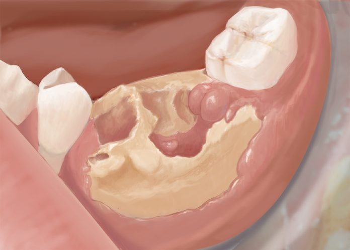 osteonecrosis-of-the-jaw-2