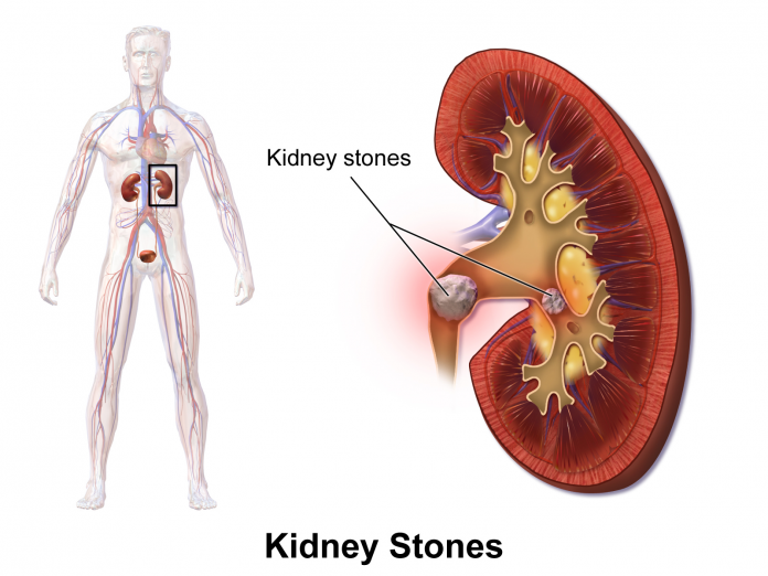 images_kidney-stones-laparoscopic-1