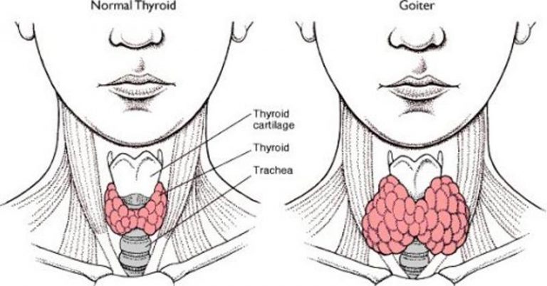 Πώς η κακή υγεία του εντέρου προκαλεί υποθυρεοειδισμό