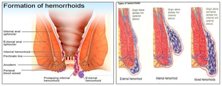 Θεραπευτικός οραματισμός για να εξαφανίσετε τις αιμορροϊδες