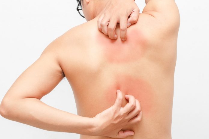 psoriasis 1