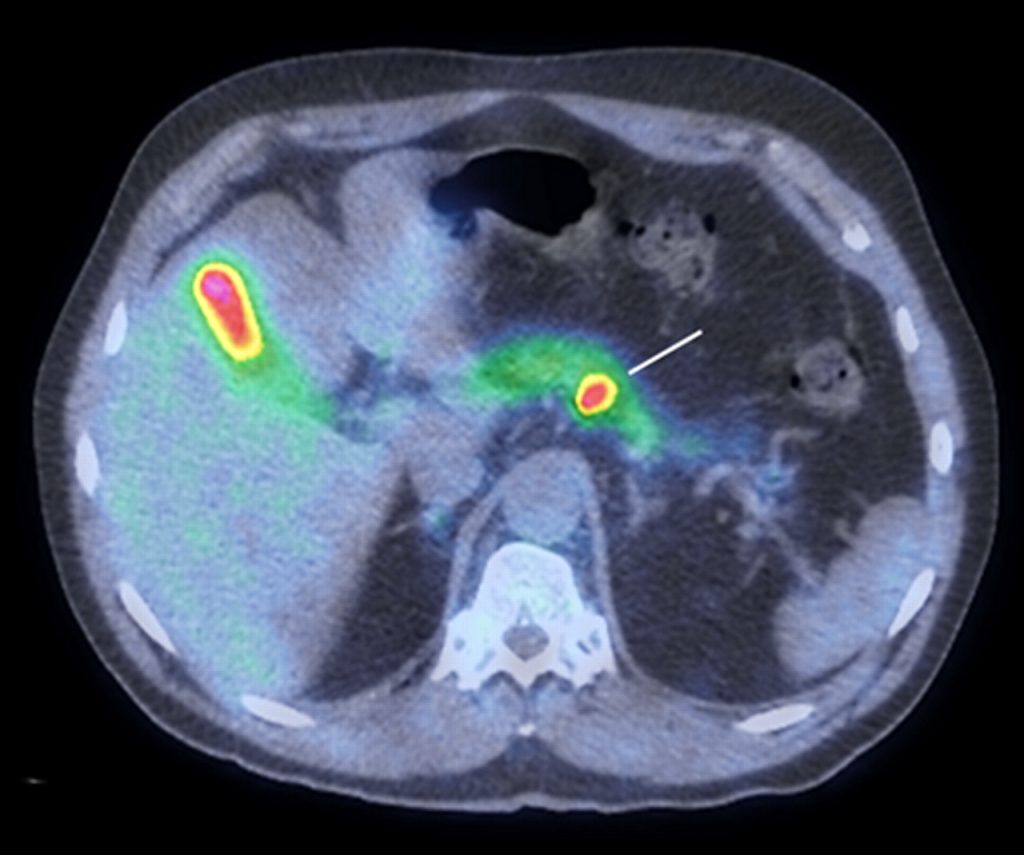 insoulinoma 2