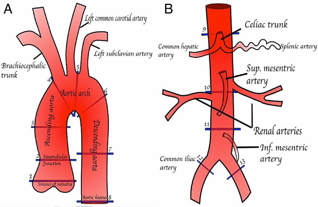 stenosis aorta 2