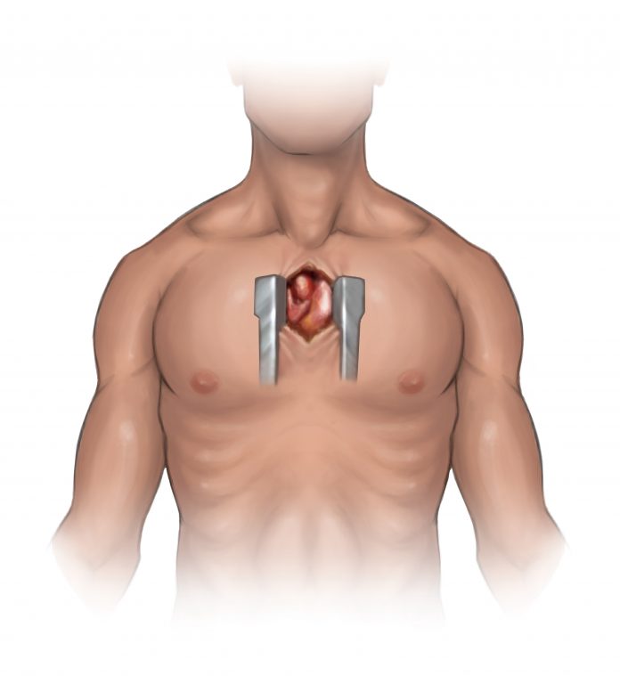 stenosis aorta 4