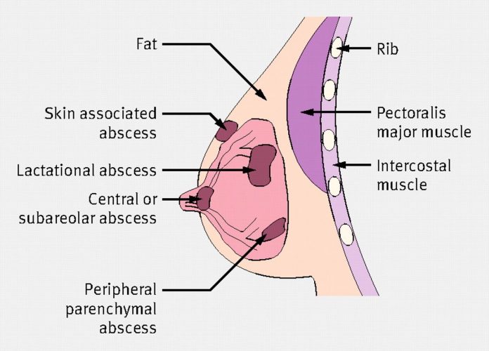 breast abcess 1