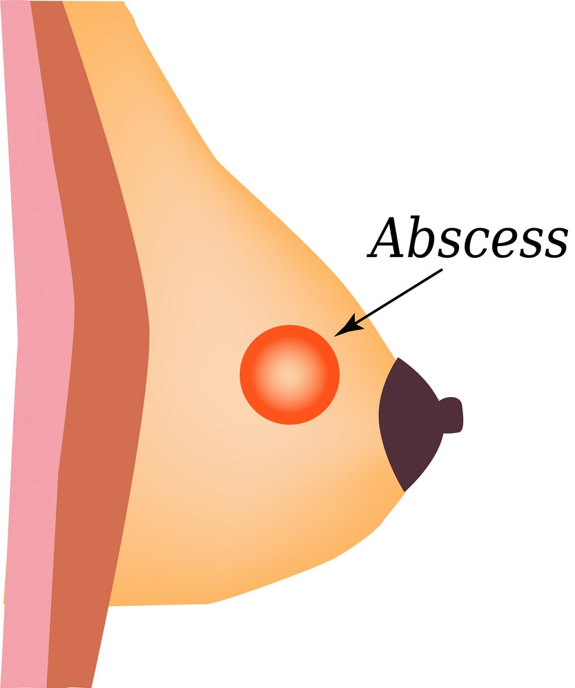 breast abcess 4