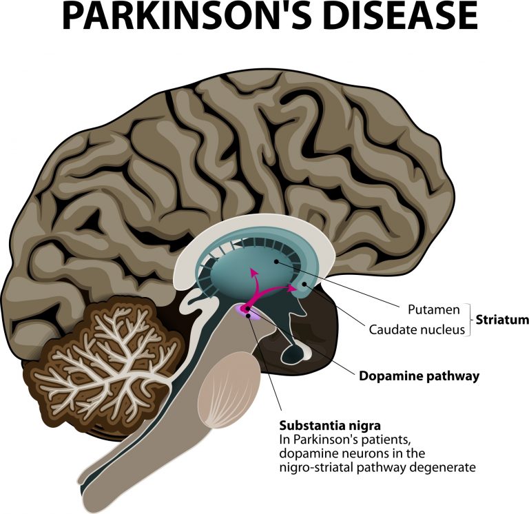 Κάνναβη και νόσος του Πάρκινσον