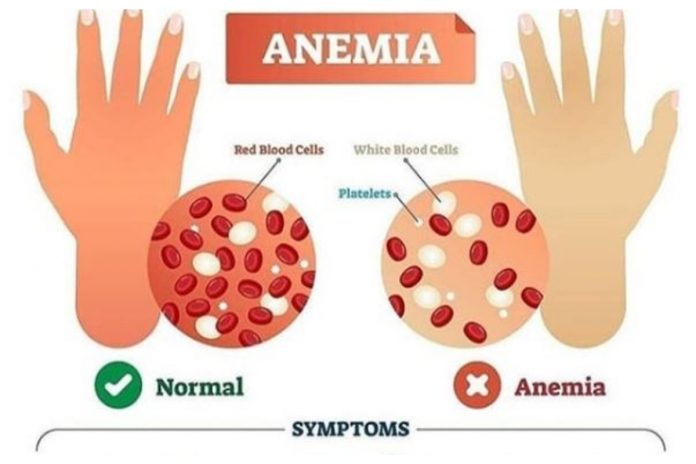 anemia 1