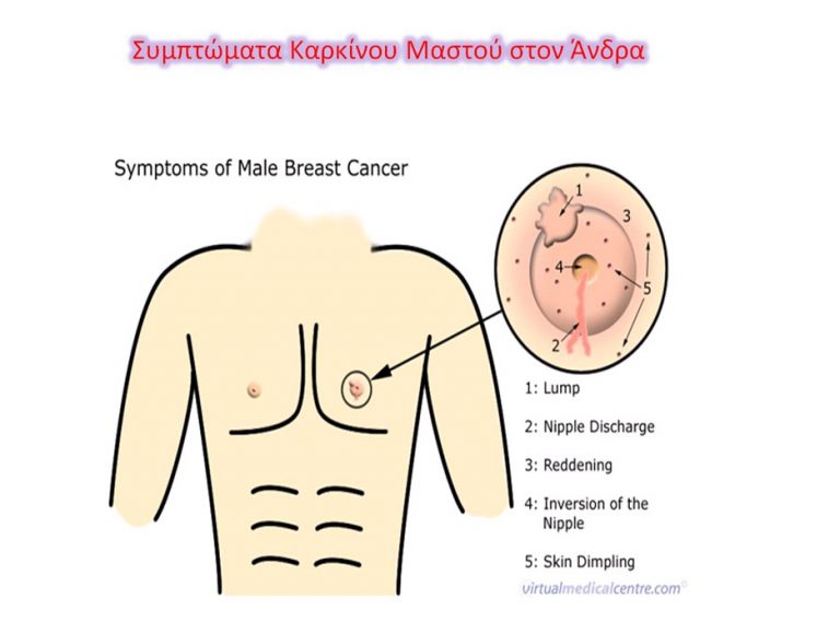 Καρκίνος του μαστού στον άνδρα