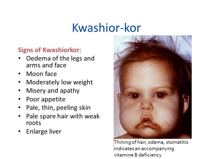 Kwashior korSignsofKwashiorkor