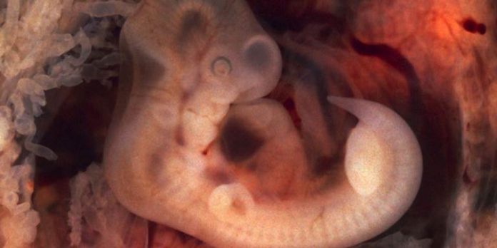 720px Tubal Pregnancy with embryo