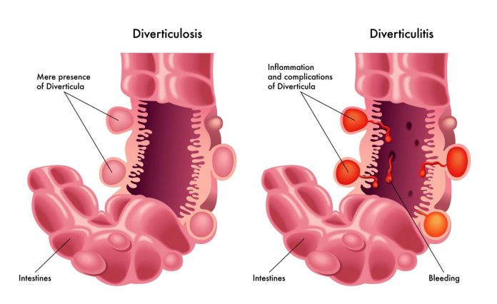 Diverticulosis Singapore