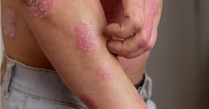 What Is The Best Dyshidrotic Eczema Treatment 1