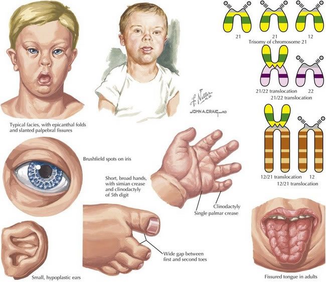 articles typical traits associated with down syndrome