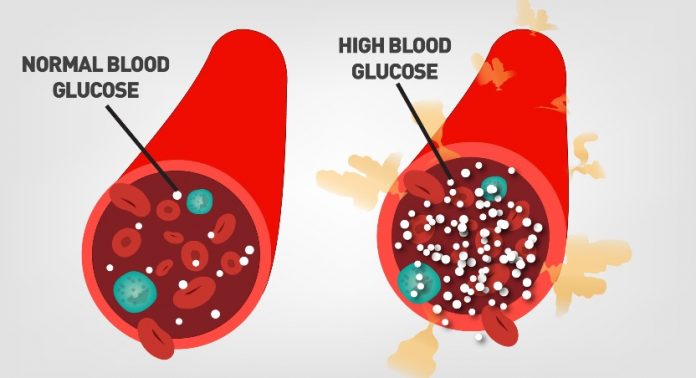 Hyperglycemia high blood sugar