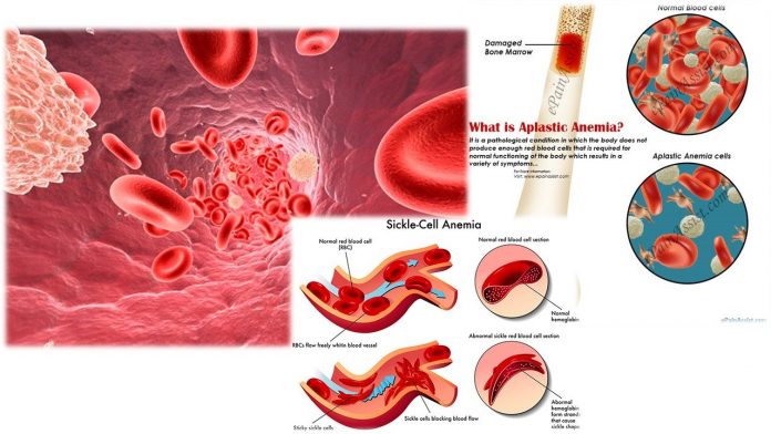 Aplastic Anemia Epidemiology Forecast to 2025