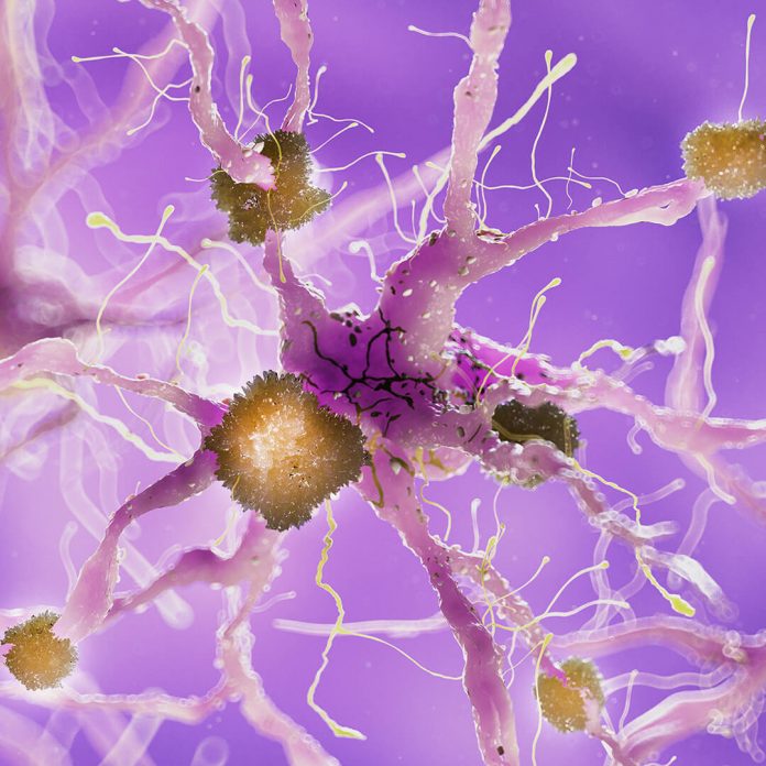 amyloeidosis 4 amyloeidosis 4
