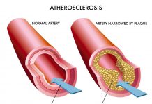Atherosclerosis Singapore
