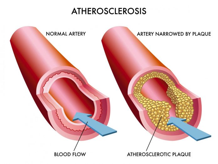 Atherosclerosis Singapore