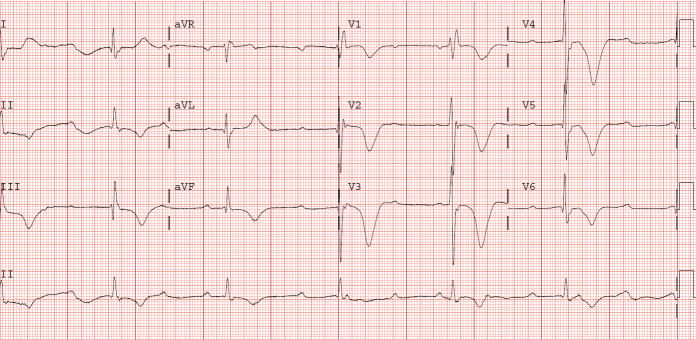 First ECG of Stokes Adams attack