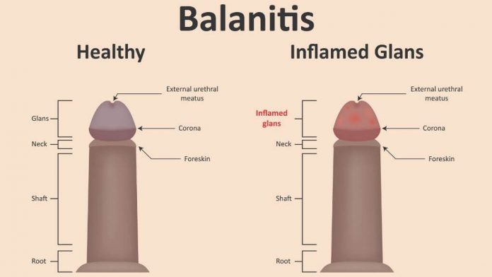 balanitis mens health 1