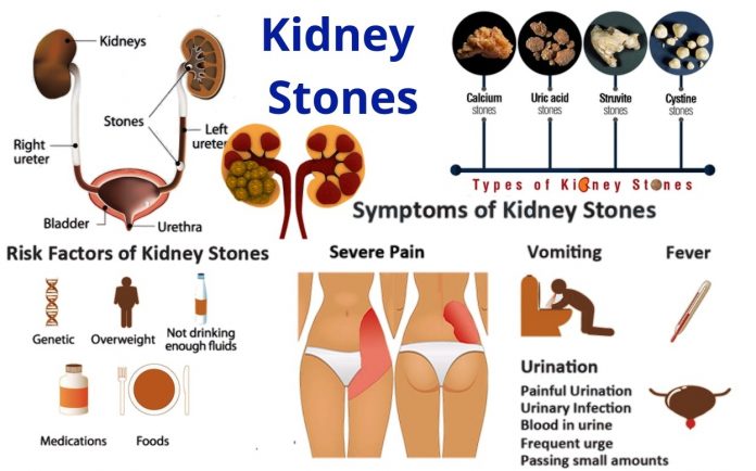 KidneyStone Urolithiasis Homeopathic Treatment india punjab DrMakkar