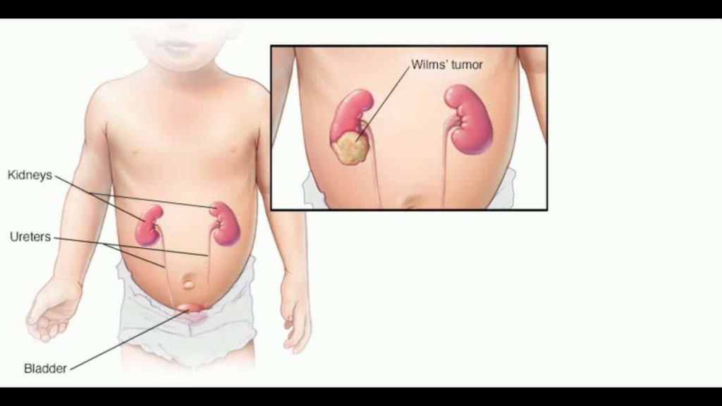 med wilms tumour