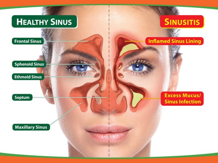 sinus disease
