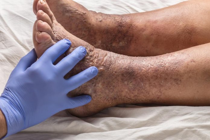 varicose dermatitis or eczema on ankle