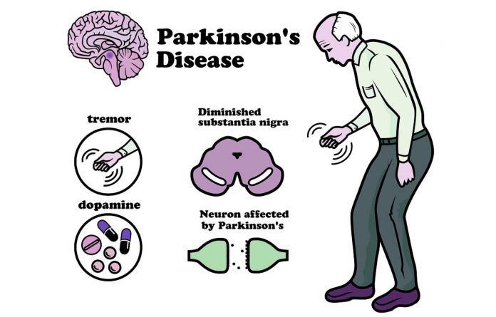 134673 parkinsons disease