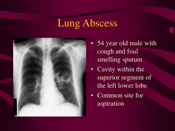 lung abscess2 l