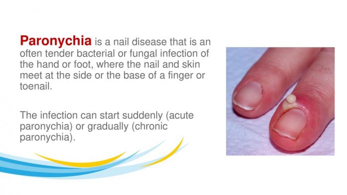 Paronychiaisanaildiseasethatisanoftentenderbacterialorfungalinfectionofthehandorfootwherethenailandskinmeetatthesideorthebaseofafingerortoenailjpg