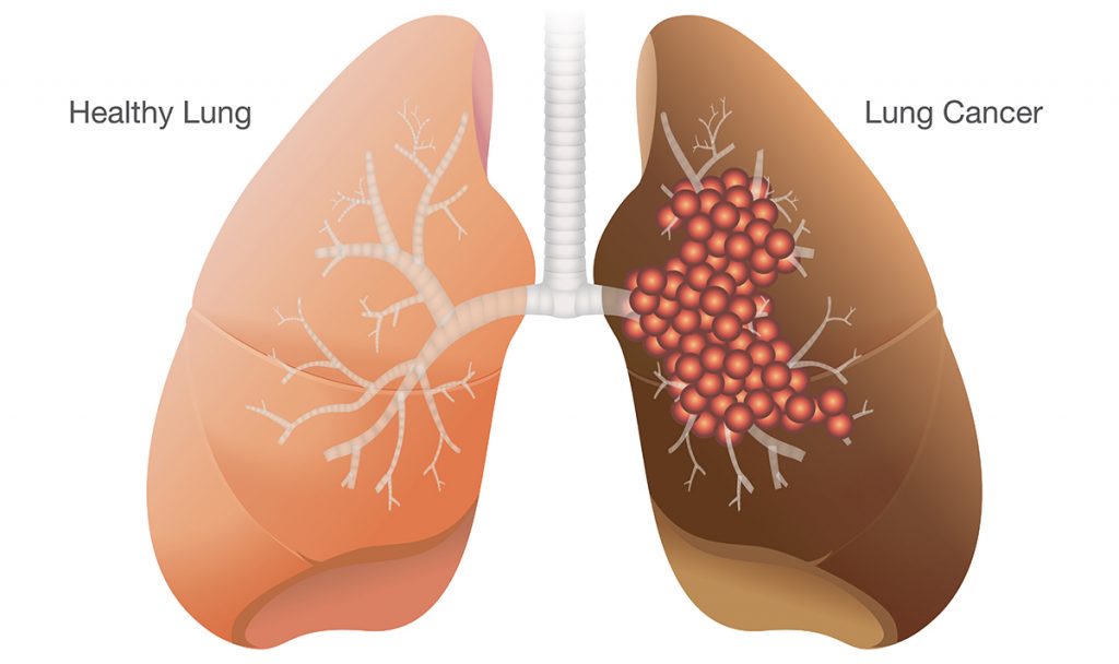 lung cancer