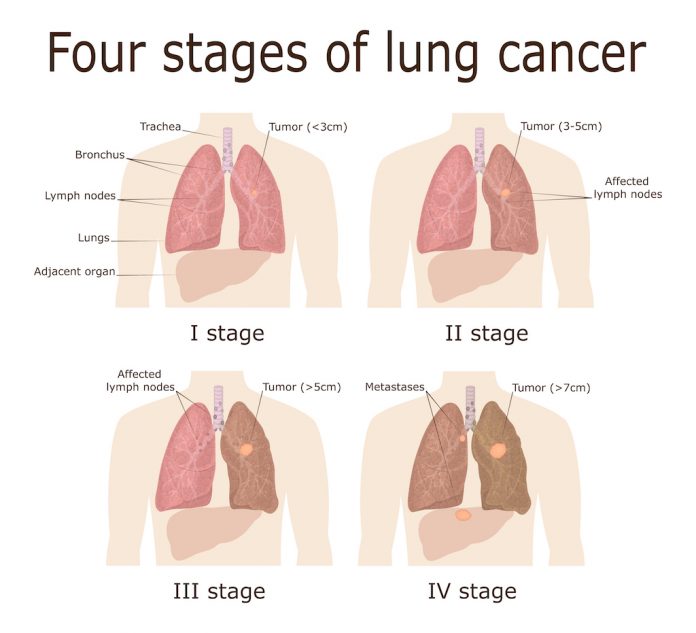 lung cancer stages