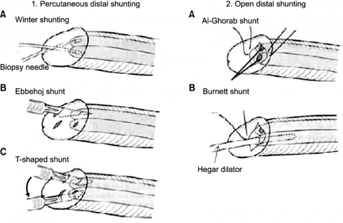Schemes of surgical shunting for the treatment of ischemic priapism Data from Japanese