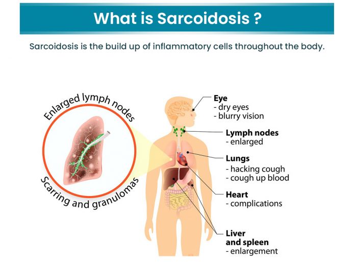 sarcoidosis main sarcoidosis main