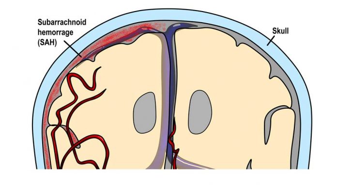 Subarachnoid Hemorrhage 1