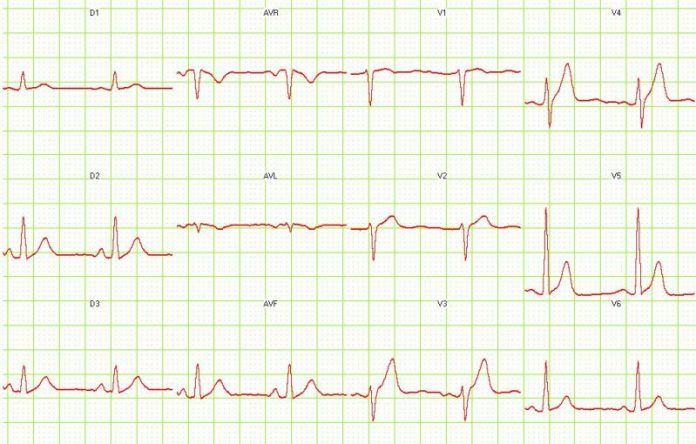ecg hypercalcemia ecg hypercalcemia