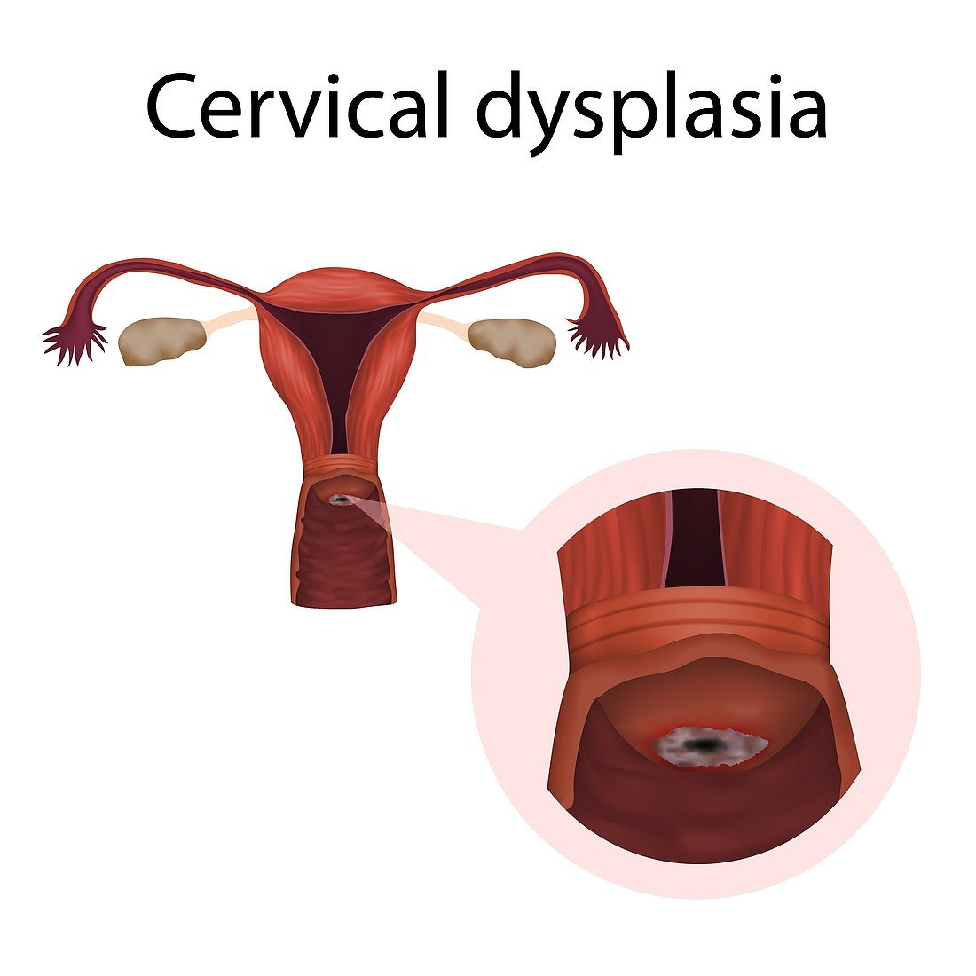 12959075 Cervical dysplasia illustration