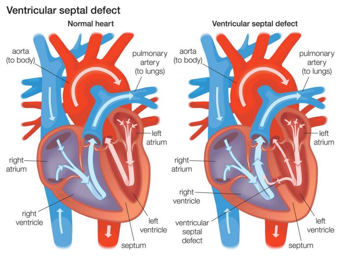 Ventricular septal defect