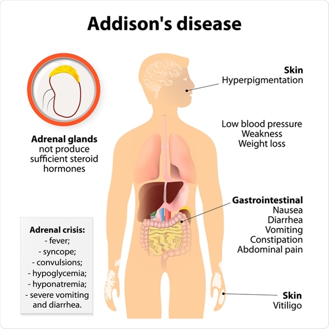 Νόσος του Addison
