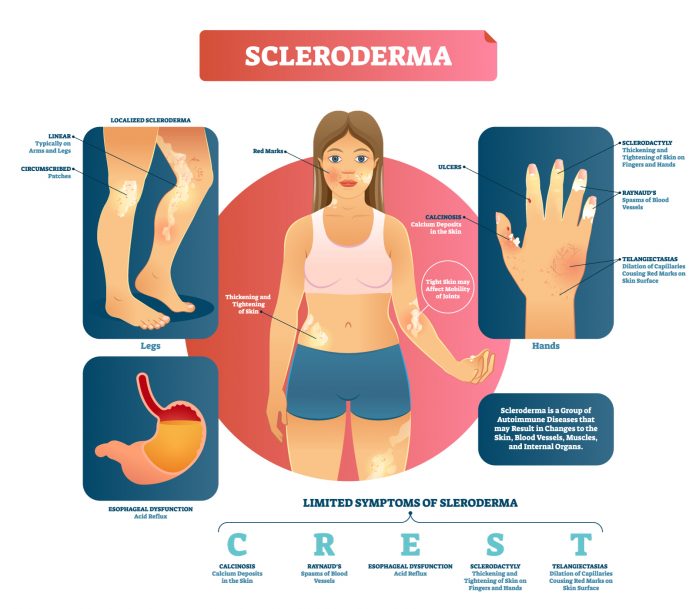 scleroderma