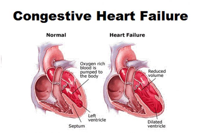 Congestive Heart Failure 1