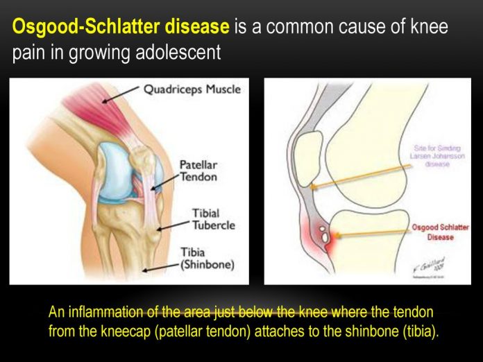 Osgood Schlatterdiseaseisacommoncauseofkneepainingrowingadolescent