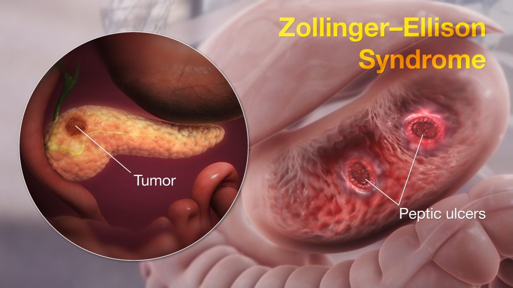 Zollinger Ellison Syndrome shown using medical animation still shot